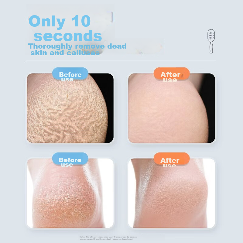 Xiaotianlai Foot File, Pumice Stone, Foot Scrubber, Callus Remover, Heel Scraper...